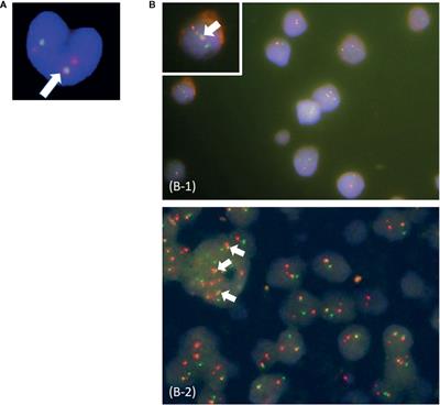 Multi-Lineage BCR-ABL Expression in Philadelphia Chromosome-Positive Acute Lymphoblastic Leukemia Is Associated With Improved Prognosis but No Specific Molecular Features